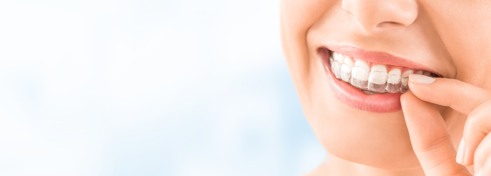 beneficios-de-la-ortodoncia-invisible