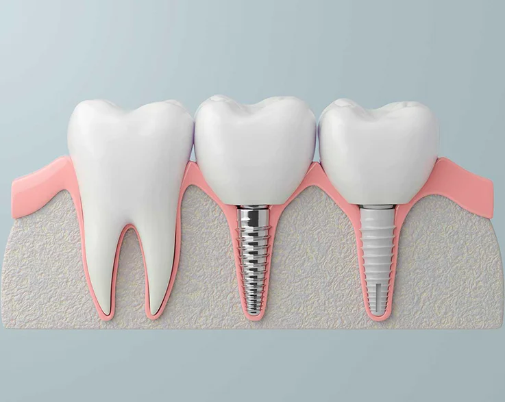 Implants dentals