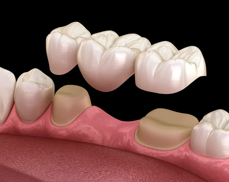Implants dentals